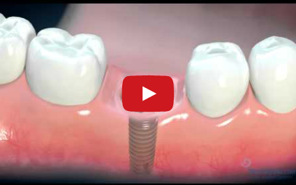 DM_il dentista moderno_implantologia_paziente_informazioni