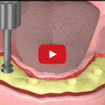 Riabilitazione Mandibola edentula : overdenture su impianti e carico immediato DM_il dentista moderno_overdenture su impianti a carico immediato_mandibola edentula