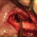 Perforazione di membrana durante rialzo di seno mascellare DM_il dentista moderno_perforazione membrana rialzo di seno mascellare