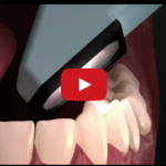 Come il paziente vive la presa di impronte in odontoiatria DM_il dentista moderno_presa di impronte in odontoiatria_paziente