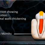 Rigenerativa endodontica: discolorazioni e complicanze DM_il dentista moderno_rigenerativa endodontica_discolorazioni