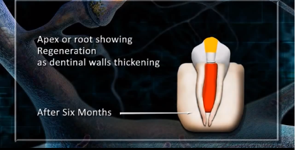 DM_il dentista moderno_rigenerativa endodontica_discolorazioni