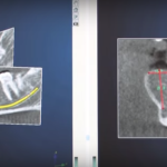 Il primo intervento di implantologia ripreso e trasmesso live DM_il dentista modenro_implantologia_primo impianto