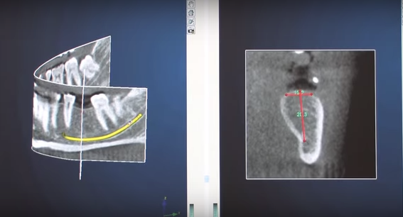 DM_il dentista modenro_implantologia_primo impianto