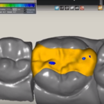 Resistenza alla frattura degli intarsi inlay CAD-CAM DM_il dentista moderno_Resistenza alla frattura degli intarsi inlay CAD-CAM