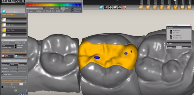 DM_il dentista moderno_Resistenza alla frattura degli intarsi inlay CAD-CAM