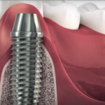 Breve compendio sui processi a carico dell’alveolo postestrattivo DM_il dentista moderno_compendio alveolo post estrattivo