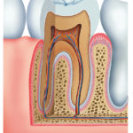Le metalloproteinasi di membrana e l’adesione in odontoiatria restaurativa DM_il dentista moderno_metalloproteinasi odontoiatria restaurativa