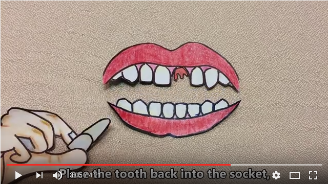 DM_il dentista moderno_prevenzione dei traumi dentari