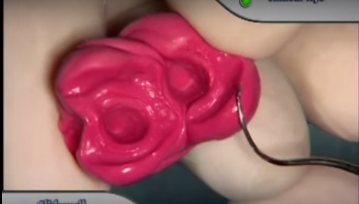 DM_il dentista moderno_registrazione occlusale