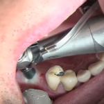 Chirurgia implantare flapless nel settore posteriore del mascellare superiore Chirurgia implantare flapless settore posteriore del mascellare superiore