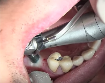 Chirurgia implantare flapless settore posteriore del mascellare superiore