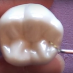 Anatomia molari inferiori dm_il-dentista-moderno_anatomia-molari-mandibolari