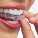 5 milioni di pazienti: nuovo traguardo per Invisalign dm_il-dentista-moderno_invisalign_sorriso_allign-technology