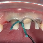 Fitting di protesi CAD/CAM: sistemi di misurazione dm_il-dentista-moderno_protesi-cadcam