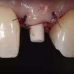 Restauri metal-free in ambito protesico DM_il dentista moderno_restauri metal-free