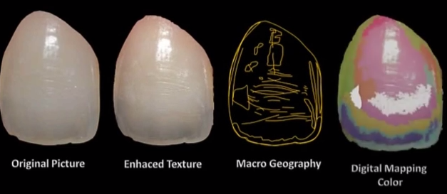 DM_il dentista moderno_scelta del colore_restaurativa conservativa odontoiatria