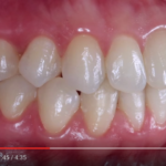 Tecniche e posizioni per fotografie in odontoiatria dm_il-dentista-moderno_tecniche-posizioni-fotografiche-in-odontoiatria