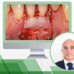 Lembo coronale in chirurgia estetica mucogengivale di Giovanni Zucchelli chirurgia_mucogengivale_zucchelli