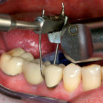 Il ritrattamento endodontico: indicazioni, strumenti consigliati e procedure