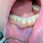 Un raro caso di cisti parodontale laterale: caso clinico