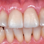 Nuovi materiali e protocolli semplificati per una protesi di qualità