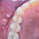 Trattamento di un’atrofia verticale mascellare con tecnica combinata: innesto in blocco e rialzo di seno mascellare