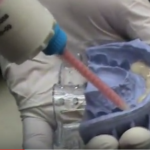 Provvisorizzazione nelle riabilitazioni con faccette estetiche dm_il-dentista-moderno_shrink-wrap-provvisorizzazione-faccette-estetiche