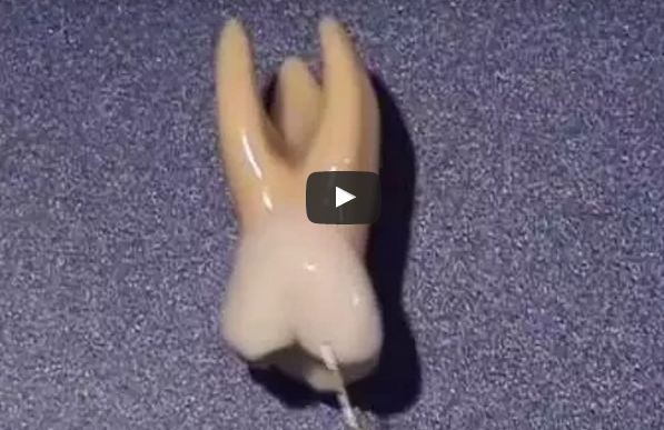 dm_il-dentista-moderno_anatomia-molari-superiori_primo-molare-superiore_secondo-molare-superiore_terzo-molare-superiore