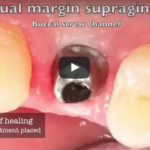 Cementazione della corona su impianto dentale dm_il-dentista-moderno_cementazione-su-impianto-dentale