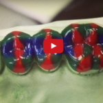 Tra diagnosi e progettazione: ceratura diagnostica dm_il-dentista-moderno_ceratura-diagnostica_diagnosi-progettazione