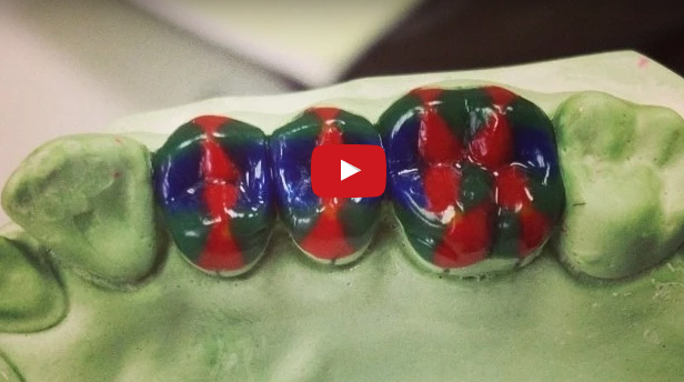 dm_il-dentista-moderno_ceratura-diagnostica_diagnosi-progettazione