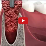 L’abc della ridge preservation dm_il-dentista-moderno_ridge-preservation