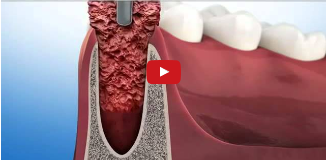 dm_il-dentista-moderno_ridge-preservation