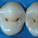 Metodiche alternative nella diagnosi carie interprossimali