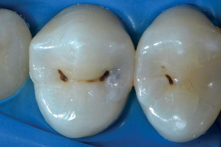 Metodiche alternative nella diagnosi di carie interprossimali