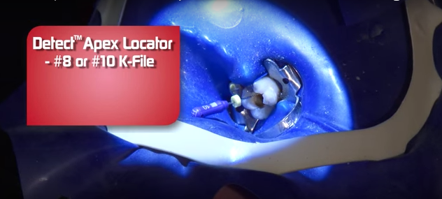 dm_il-dentista-modenro_endodonzia_rilevatore-apicale