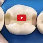 Diagnosi e classificazione della lesione cariosa dm_il-dentista-moderno_diagnosi-e-classificazione-della-lesione-cariosa