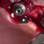 Terapia chirurgica delle perimplantiti dm_il-dentista-moderno_terapia-chirurgica-delle-perimplantiti