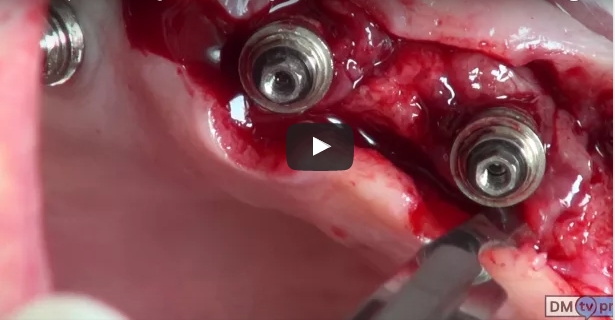 dm_il-dentista-moderno_terapia-chirurgica-delle-perimplantiti