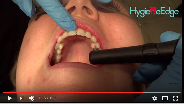 dm_il-dentista-moderno_diagnodent-carie-lesione-cariosa-diagnosi