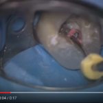 Otturatori Thermafil® e rimozione nei ritrattamenti canalari dm_il-dentista-moderno_rimozione-thermafil