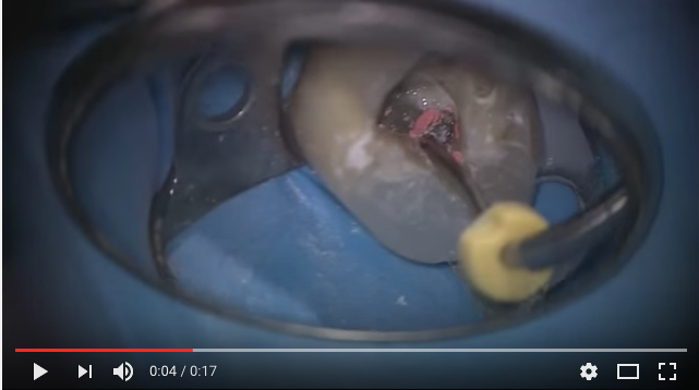 dm_il-dentista-moderno_rimozione-thermafil