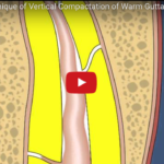 Endodonzia: concetti sulla sagomatura canalare DM_il dentista moderno_endodonzia_tecnica di Shilder_sagomatura canalare