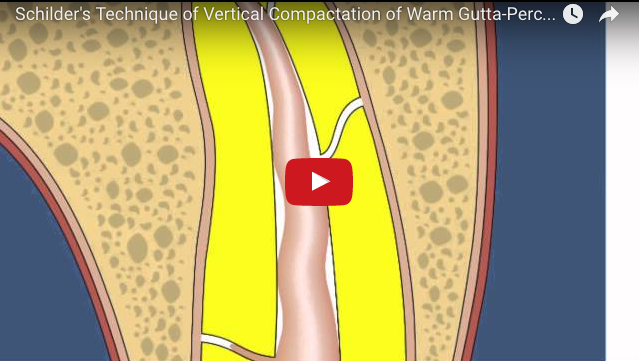 DM_il dentista moderno_endodonzia_tecnica di Shilder_sagomatura canalare