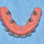 Implantologia zigomatica a carico immediato