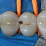 Diagnosi e prevenzione della carie mediante la tecnologia DIFOTI