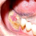 Chirurgia implantare in pazienti in terapia con farmaci anti-osteoporosi