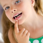 Lo splintaggio nel paziente che ha subito trauma dentario traumi dei decidui Lo splintaggio nel paziente che ha subito trauma dentario traumatologia dentale denti decidui