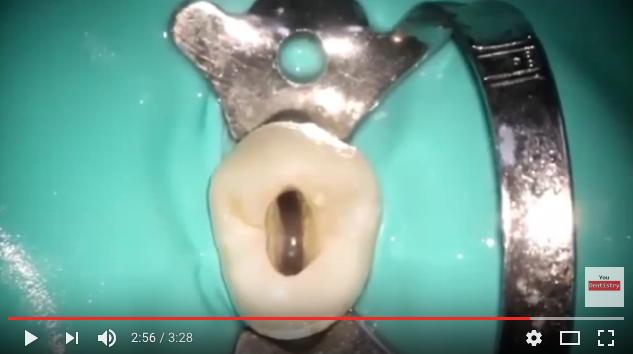 anatomia-canalare-premolari-superiori